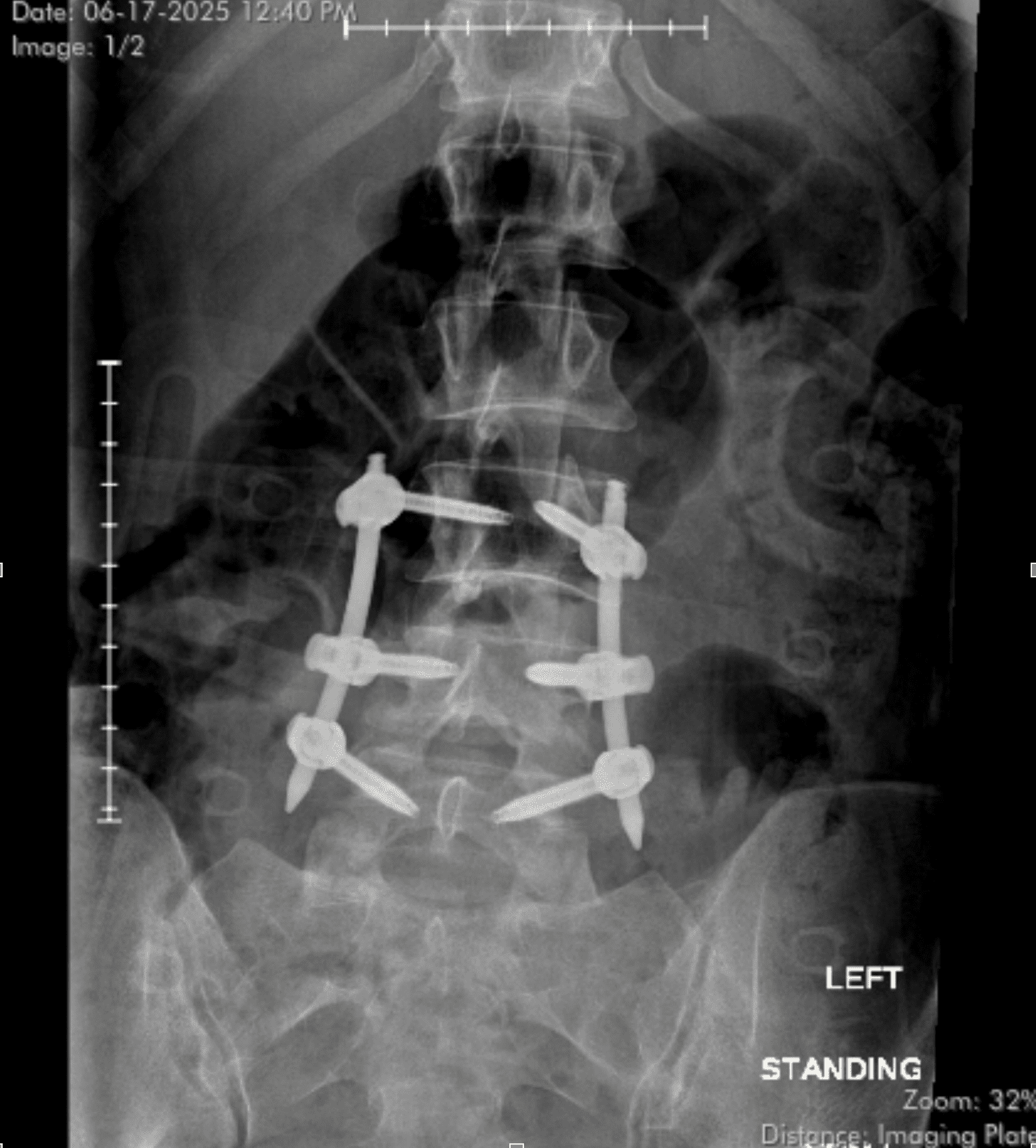 I Broke My Back. The Hardest Part Has Been Learning to Live Again.