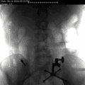 The Day My Spine Shattered—and the Surgeon Who Rebuilt It