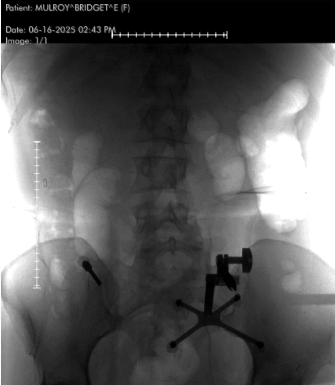 The Day My Spine Shattered—and the Surgeon Who Rebuilt It